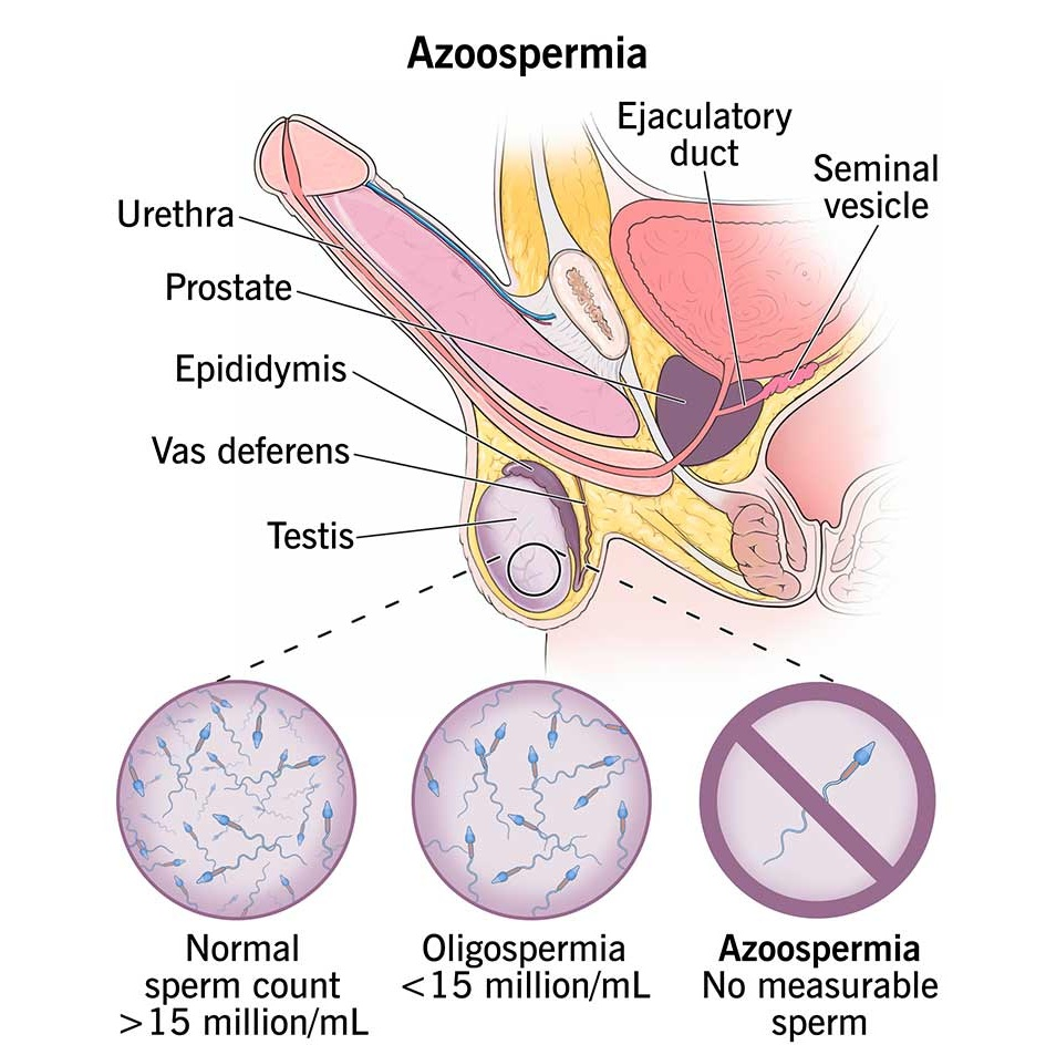 Azoospermia treatment overview - Dr. Tejas Gundewar